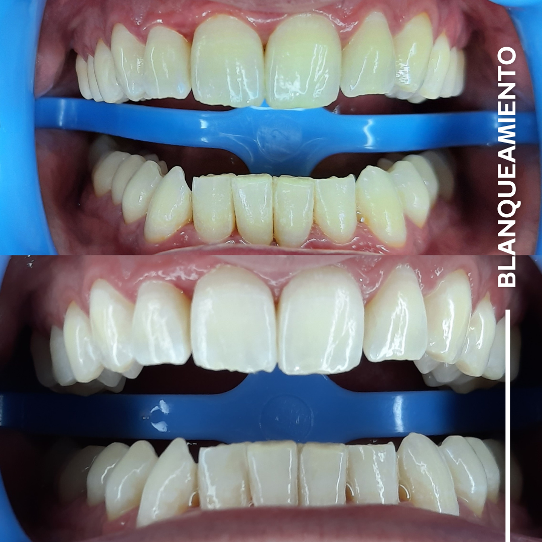 Aclaramiento dental de consultorio