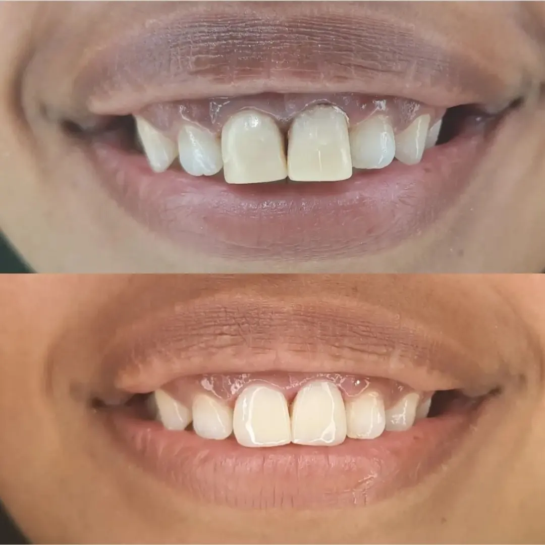 Prótesis dentales
