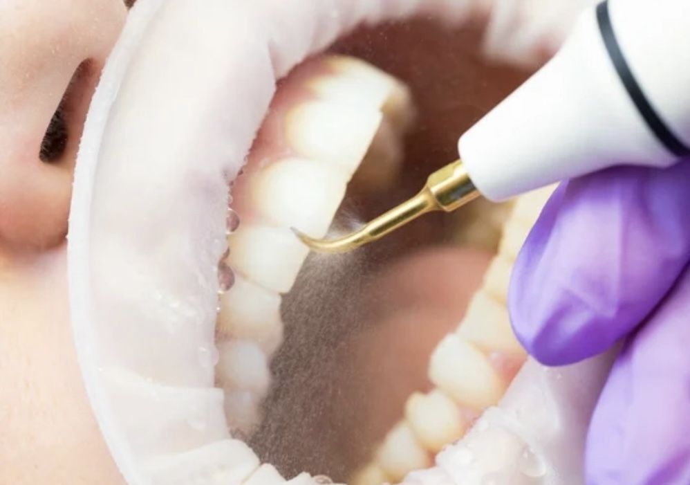 Limpieza dental con ultrasonido y profilaxis
