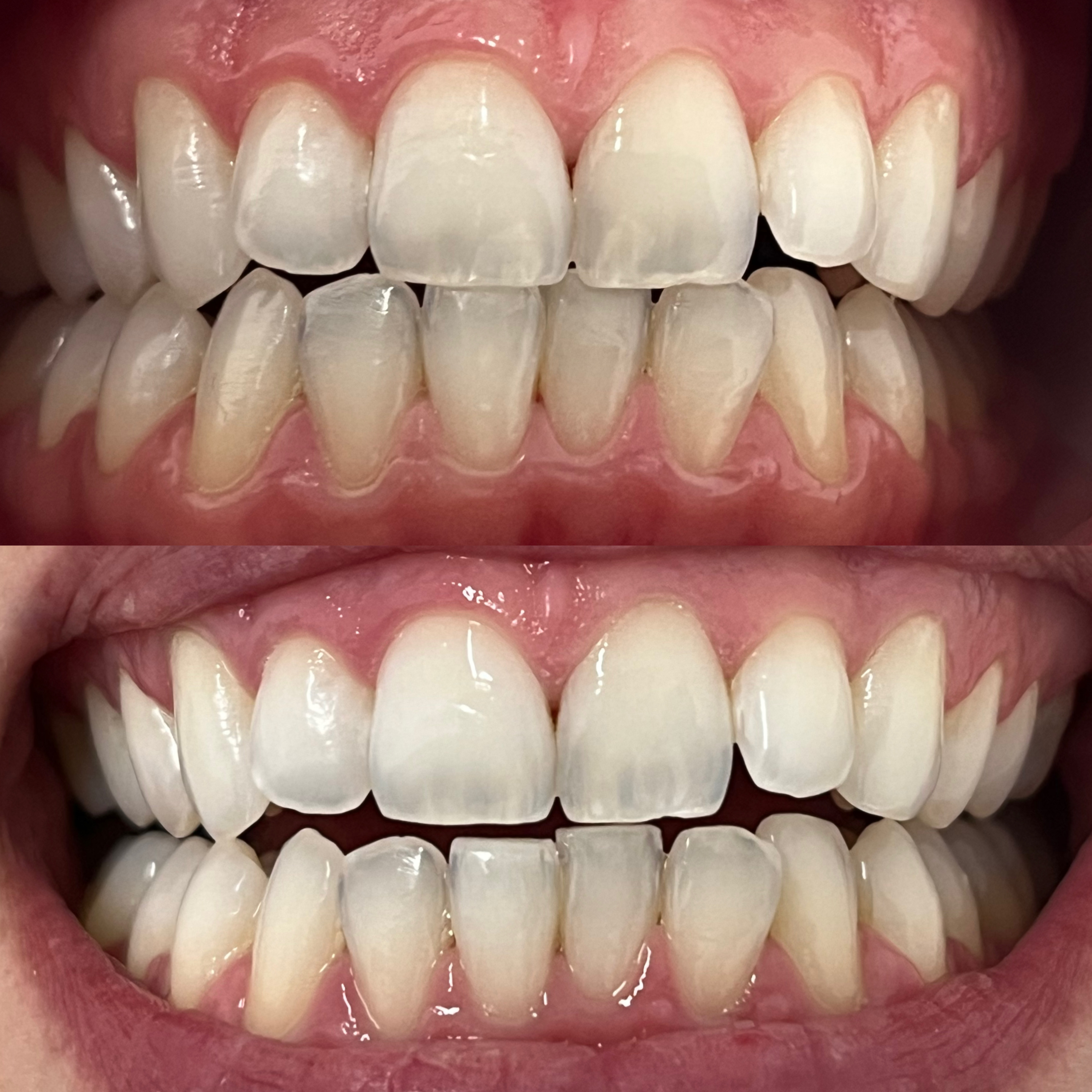 Sesión extra de aclaramiento dental de consultorio